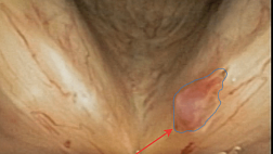Доброкачественные новообразования гортани